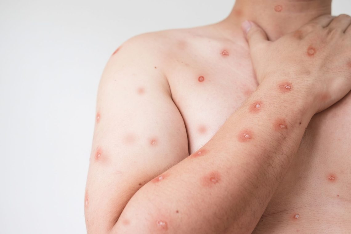 WHO odobrila prvi test za odkrivanje mpoxa
