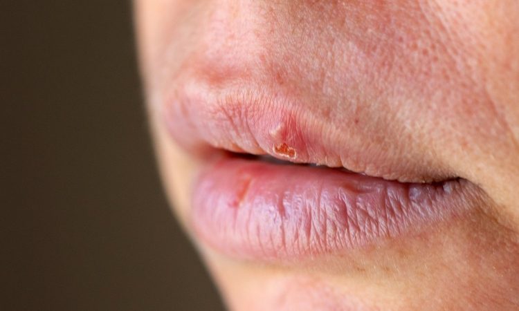 Herpes ali mozoljček: kako vedeti, kaj se je pojavilo na ustnici?