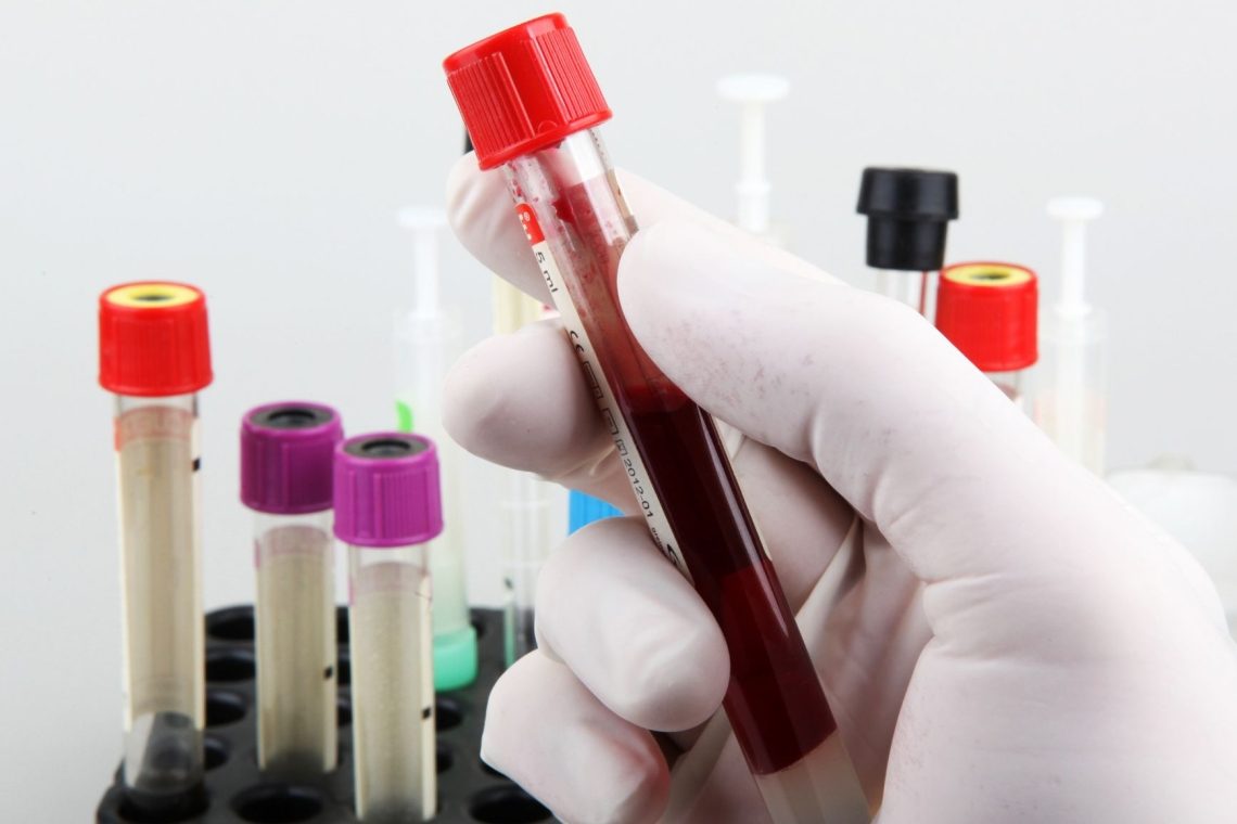 Z analizo krvi zdaj mogoče določiti biološko starost možganov